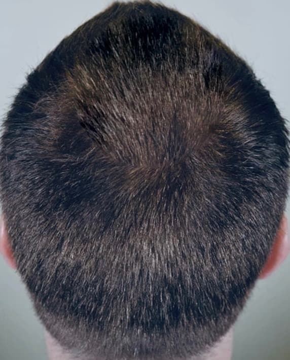 After - Hair Growth Results